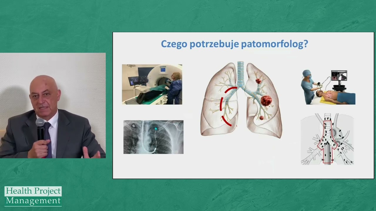 Bronchonawigacja – zastosowanie w diagnostyce raka płuca